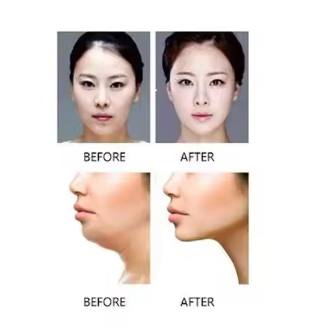 Chin Cheek Slimming V Shaper V Line Lifting