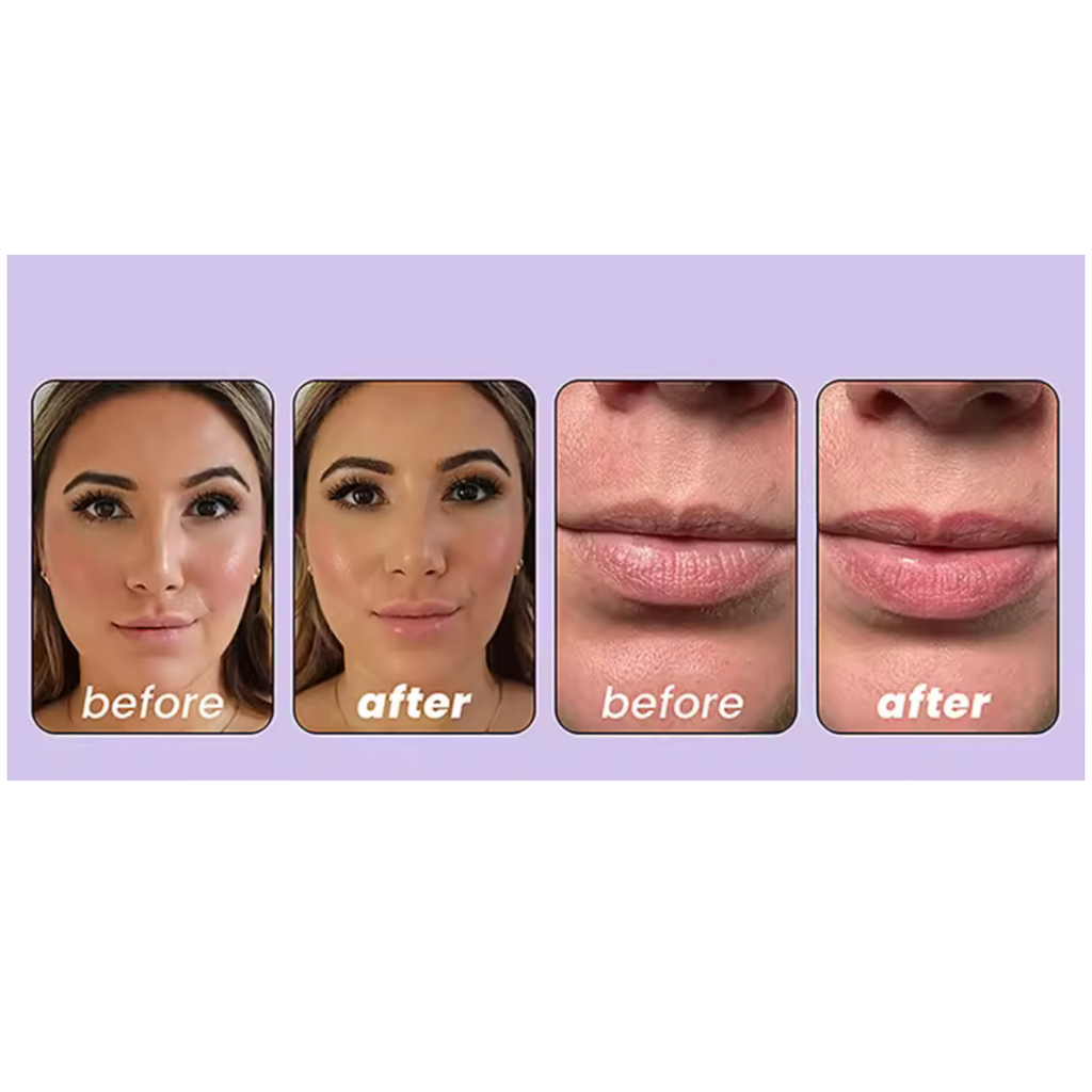 400 Hyaluronic Acid Microneedle Lip Patches For Instant Plumping & Anti Wrinkle