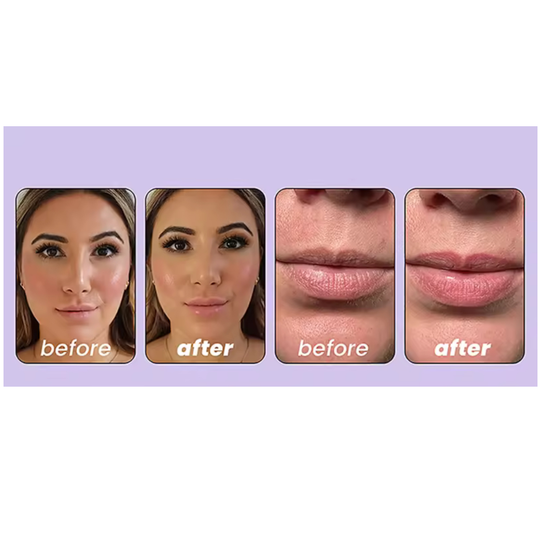 400 Hyaluronic Acid Microneedle Lip Patches For Instant Plumping & Anti Wrinkle